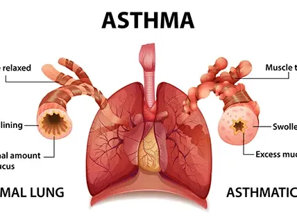 Asthma