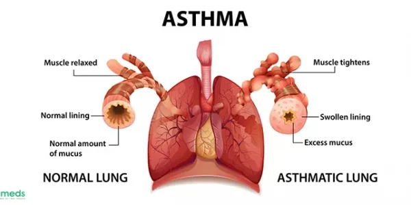 Asthma