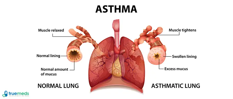 Asthma