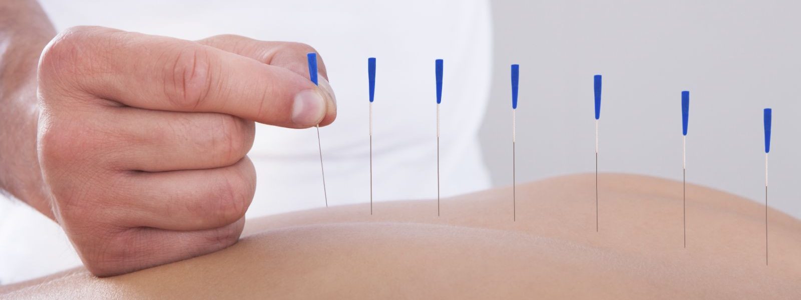 Acupuncture