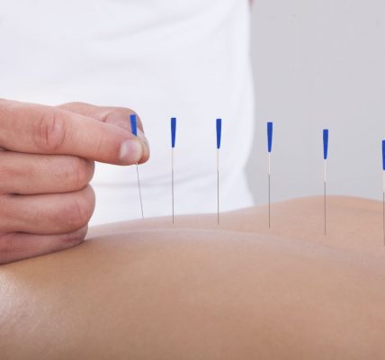 Acupuncture