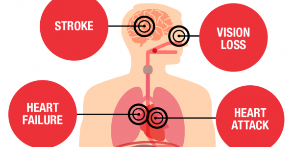 Hypertension The Silent Killer