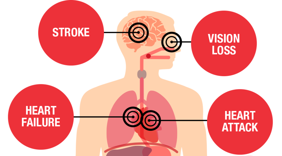 Hypertension The Silent Killer