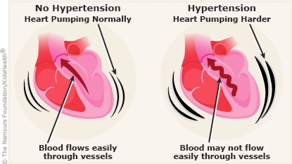 Hypertension The Silent Killer